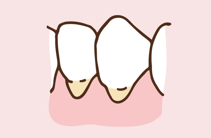くさび状欠損をご存じですか