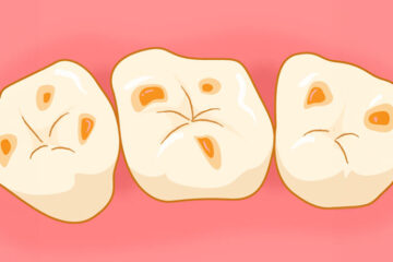 3月４日は「酸蝕歯の日」です！