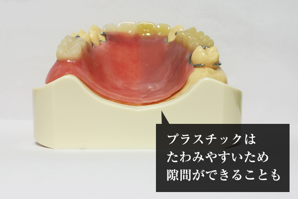 入れ歯の安定性を説明するイラスト