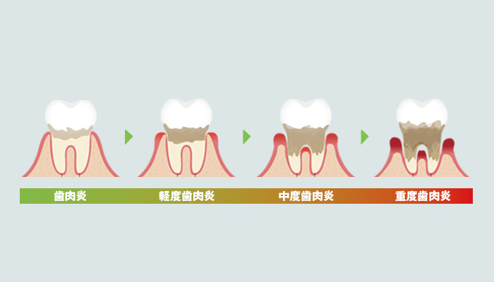 歯周病の進行を表すイラスト