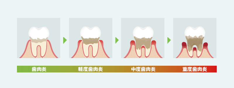 歯周病の進行を説明するイラスト