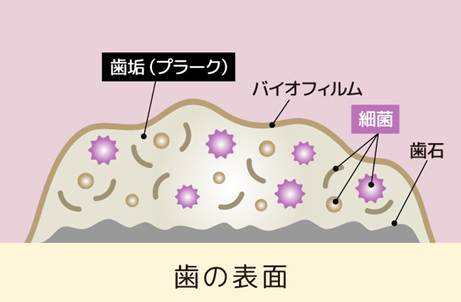 歯の表面に付着した歯垢(プラーク)・バイオフィルム・細菌・歯石の位置関係を示す断面図